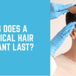 How Long Does a Non-Surgical Hair Transplant Last?