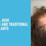 Comparing Non-Surgical Hair Transplants and Traditional Hair Transplants