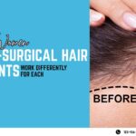 non surgical hair transplant