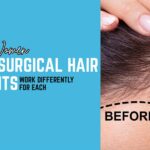 Men vs. Women: How Non-Surgical Hair Treatments Work Differently for Each