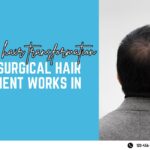non-surgical hair transplant