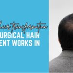 Everything You Should Know Before Getting a Hair Patch Treatment