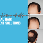 Say Goodbye to Baldness with Advanced Non-Surgical Hair Replacement