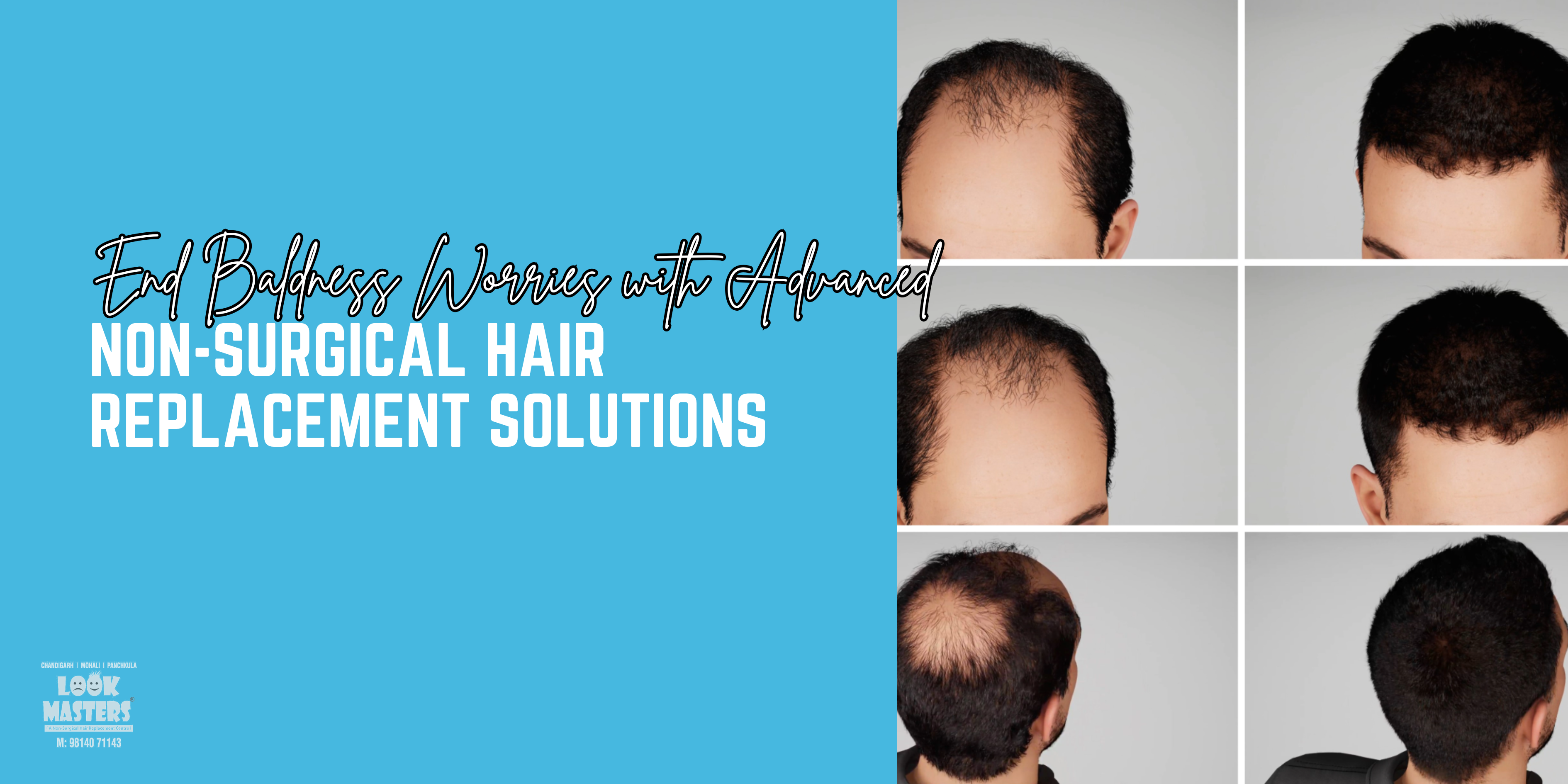End Baldness Worries with Advanced Non-Surgical Hair Replacement Solutions